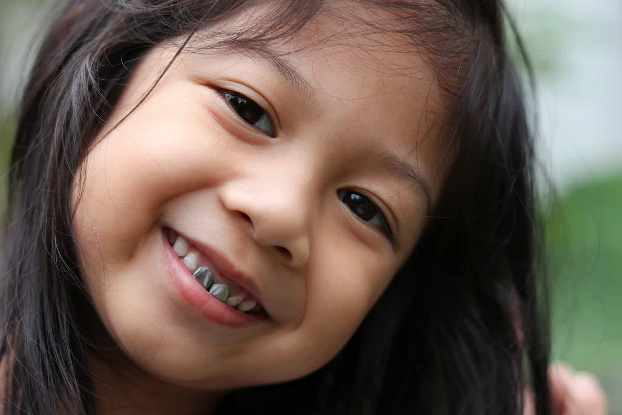 little girl smiling with dental crowns - Pediatric Dentistry on Kimball